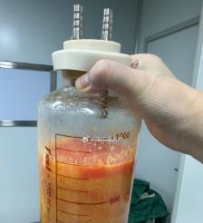 湖南水动力吸脂手术要做多久？